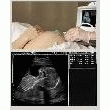 ECHOGRAPHE OBSTETRIQUE GYNECOLOGIE WED 9618