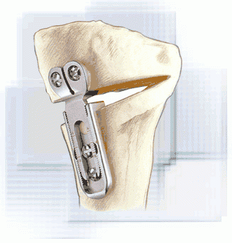 Implant modulaire osteo+_0