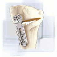 Implant modulaire osteo+
