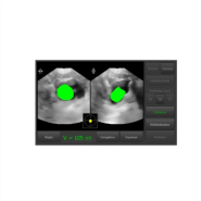 Bladder scanner VitaScan DP avec pied - Bla012 - mesure du volume de la vessie, imprimante intégrée, sonde 3D_2